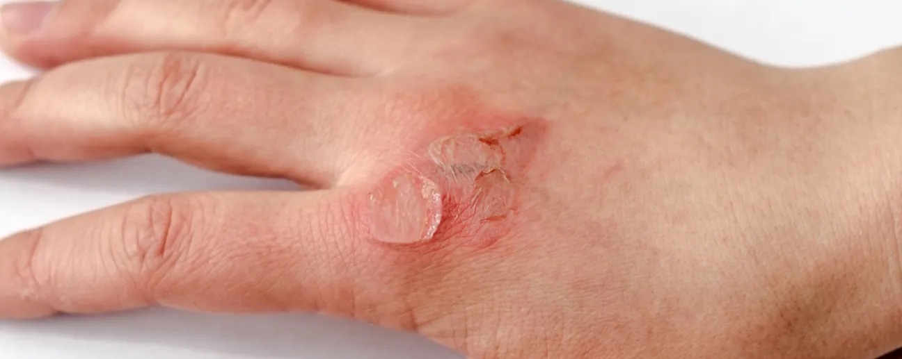 Plester Luka Plester Luka